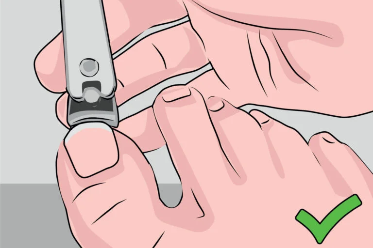 Diabetic foot care at home: Guidelines for Treatment