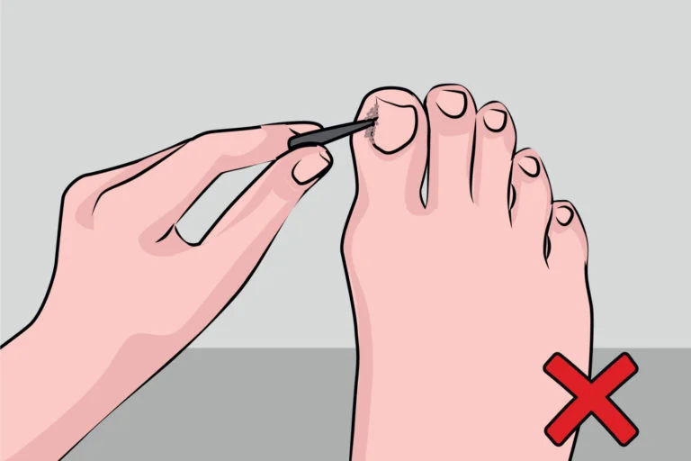 Diabetic foot care at home: Guidelines for Treatment