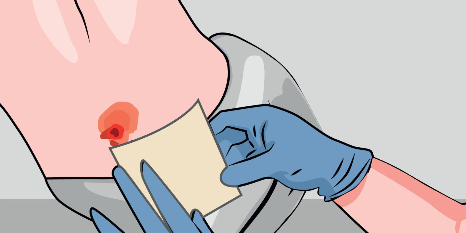 Place-the-dressing-cover-over-the-wound wound-care-at-home-healing-open-wounds