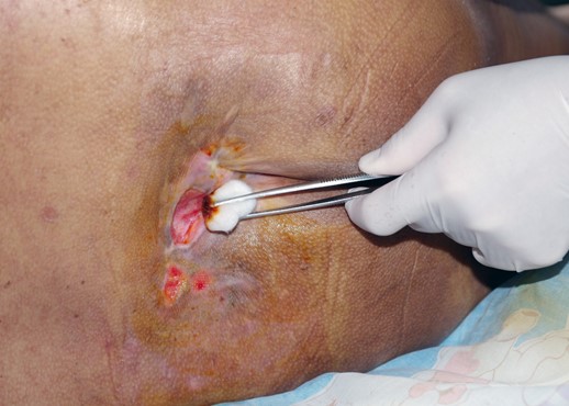 Bedsores (Pressure Ulcers) Condition, Treatments and Pictures for