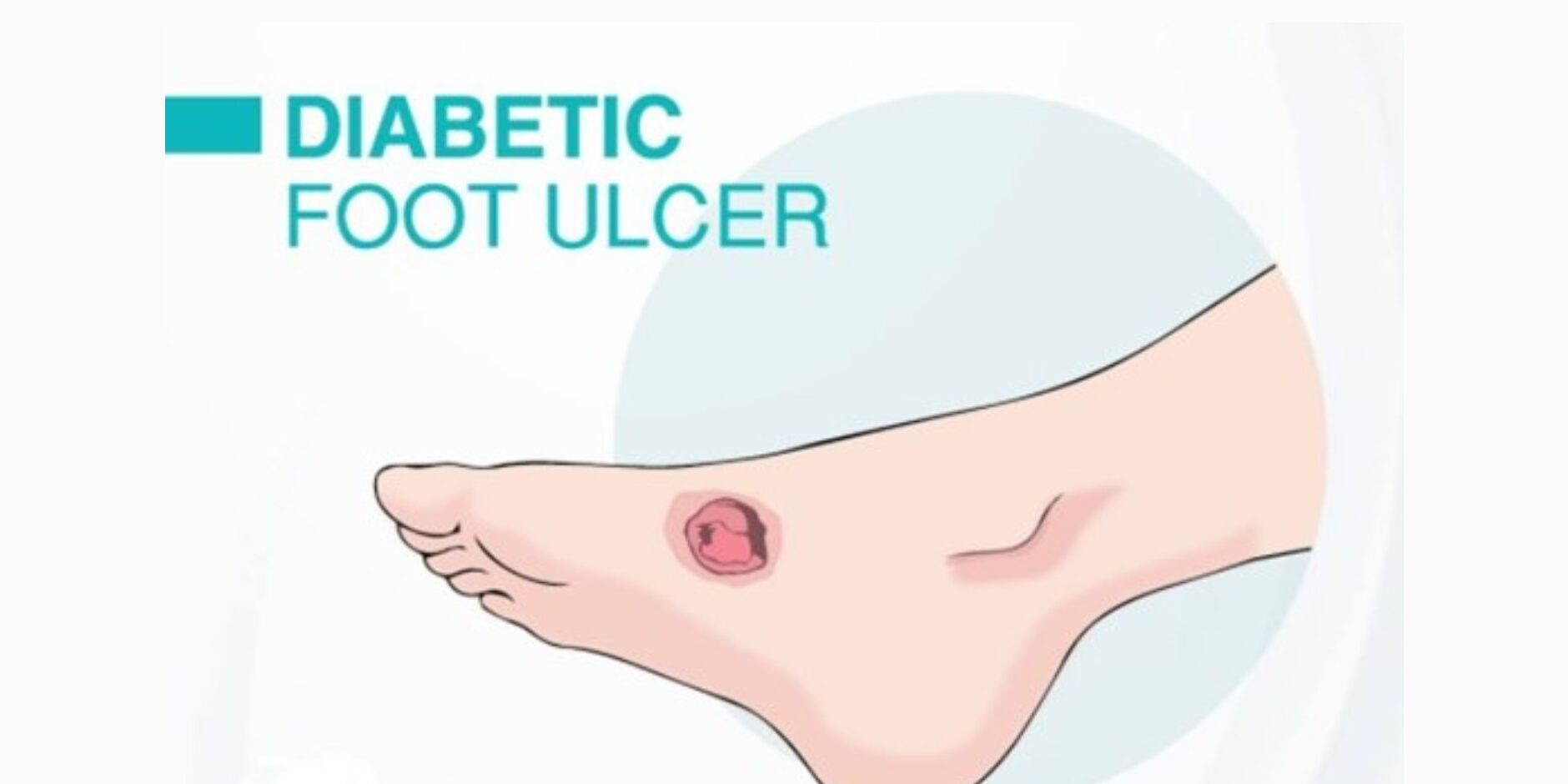 Diabetic Foot Care Easy Steps To The Healthier Foot