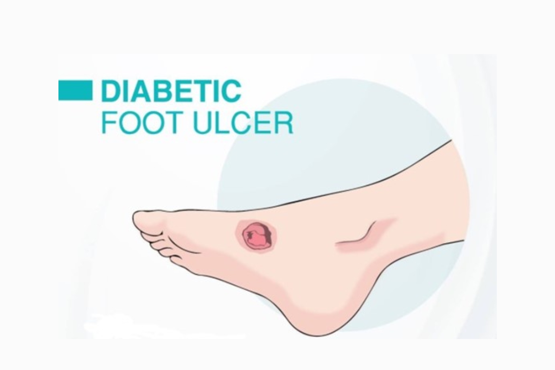diabetic-foot-care-easy-steps-to-the-healthier-foot