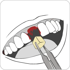 Dental Haemostatic Dressing