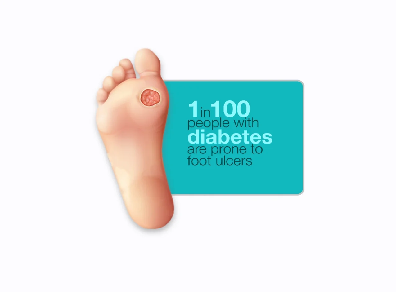 Blog | Diabetic foot ulcers: An overview | Reid Health