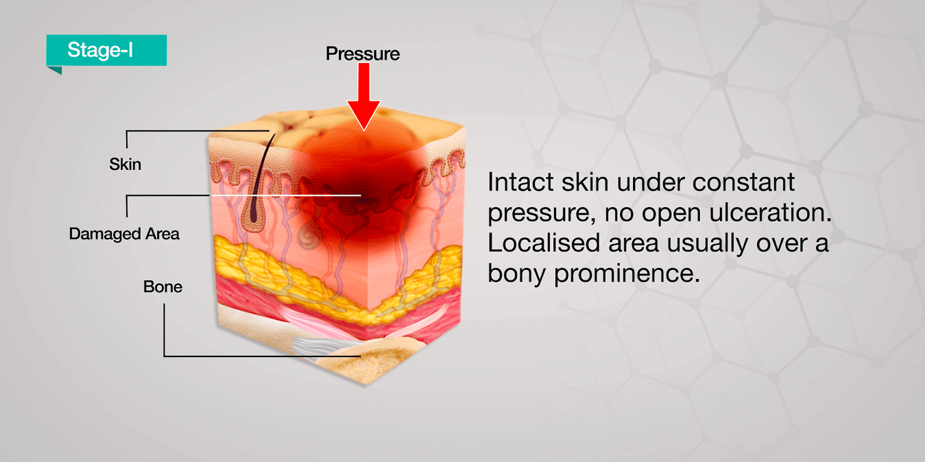 Pressure Ulcer Causes Stages Treatment Axio Biosolutions