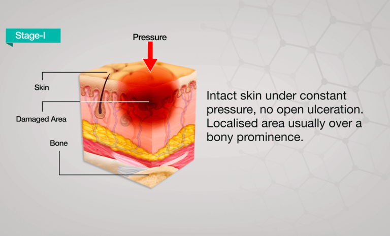 Hemostats and Wound Care Dressings from India - Axio Biosolutions