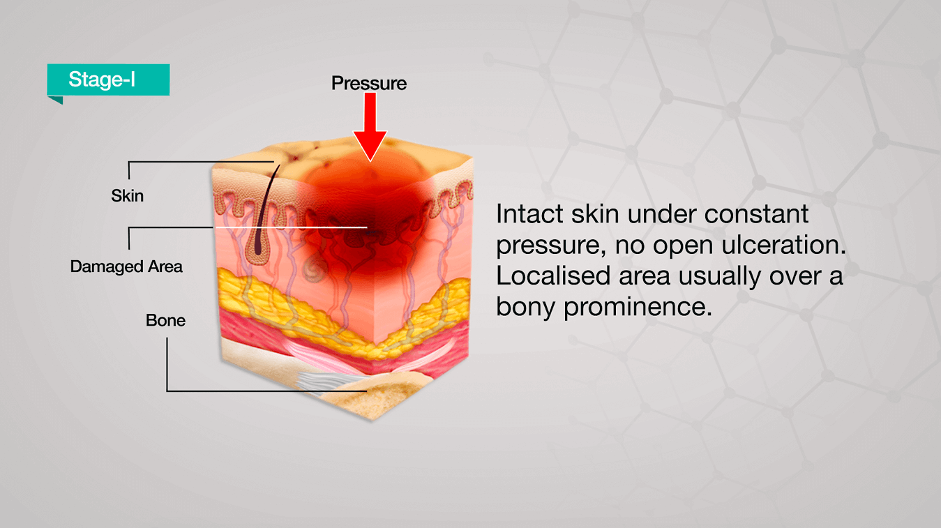 Pressure Ulcers: Causes, Stages & Treatment