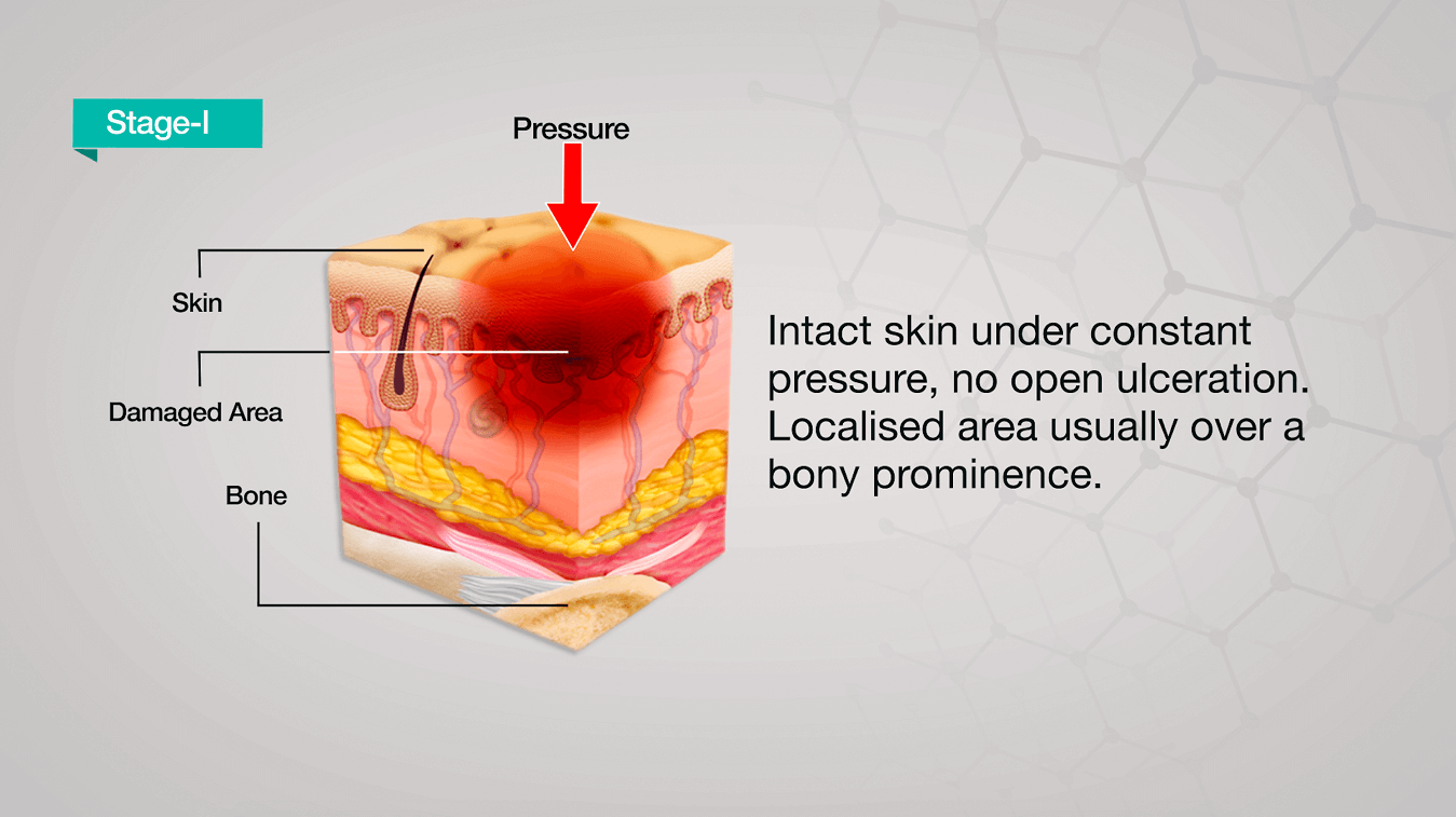 how quickly can pressure ulcers develop