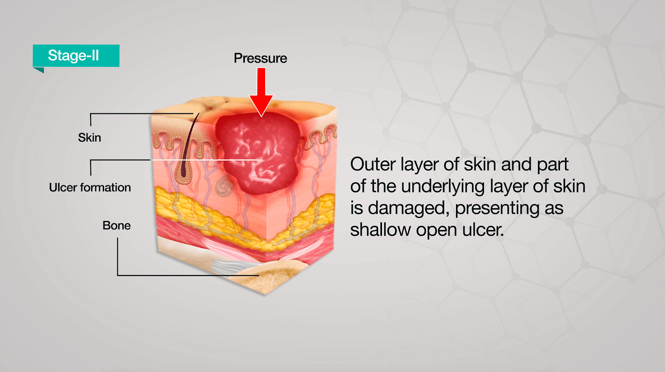 Pressure Ulcers: Causes, Stages & Treatment