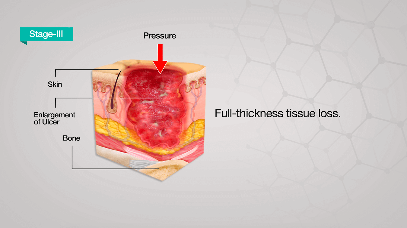 pressure-sore-ulcer-stages-bruin-blog