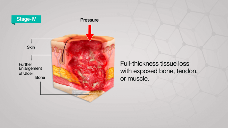 Pressure Ulcer Causes | Stages | Treatment | Axio Biosolutions