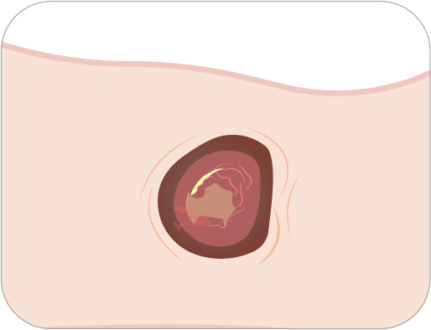 Wound Care