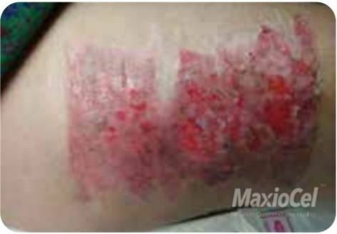SKIN GRAFT DONOR SITE
