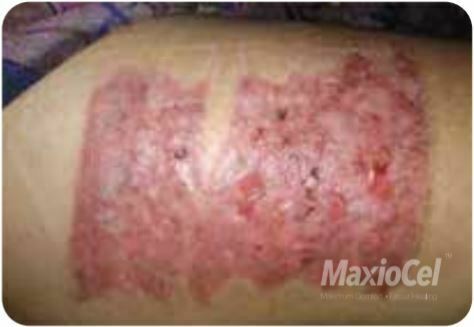 SKIN GRAFT DONOR SITE