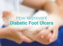 How Long Does a Diabetic Foot Ulcer Take To Heal?