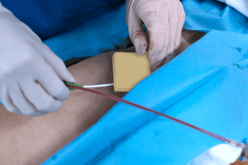 Chitosan Hemostatic Dressing