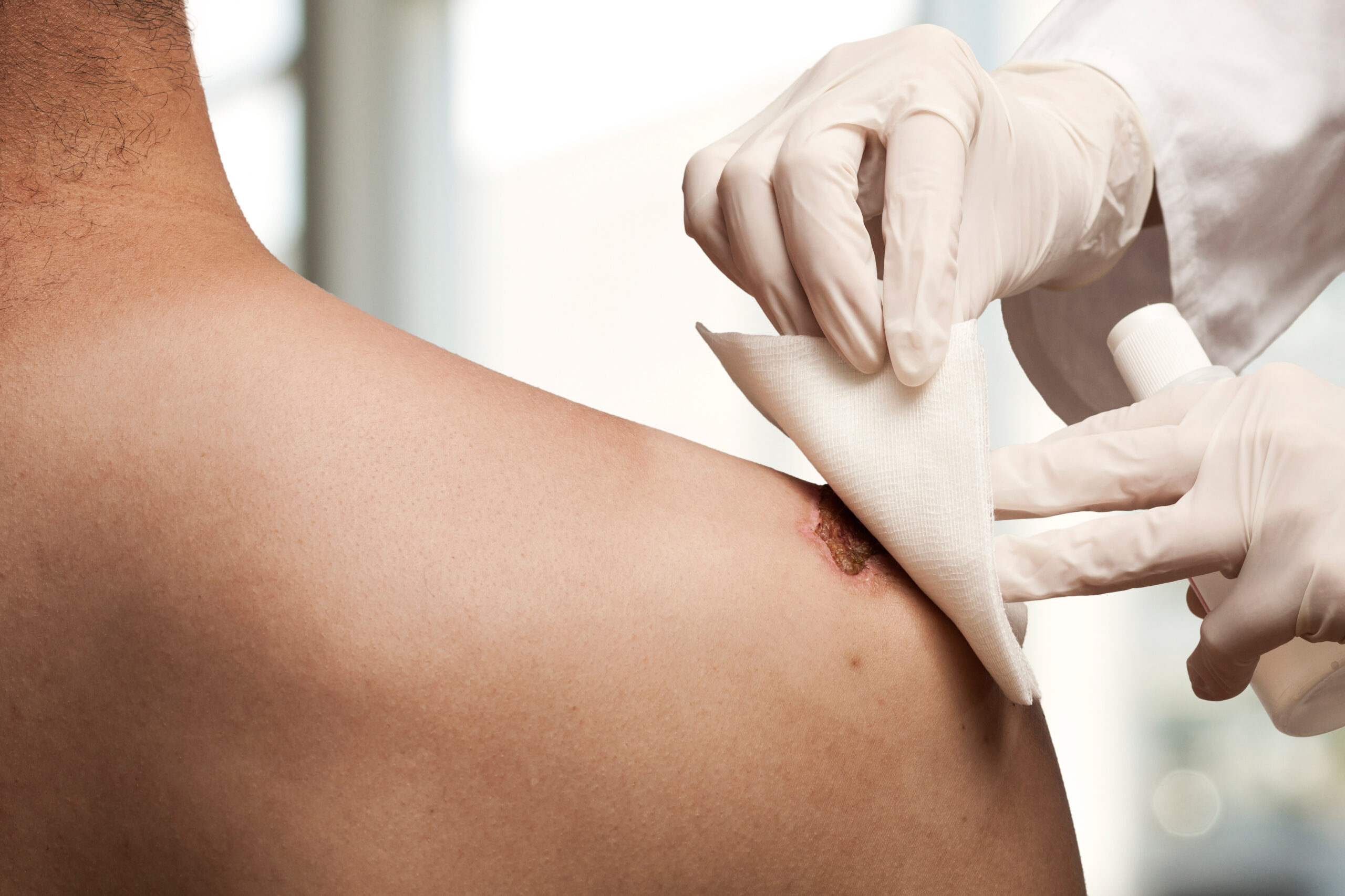 Hemostatic Dressing Hemostatic Dressing