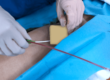 Surgical Hemostasis