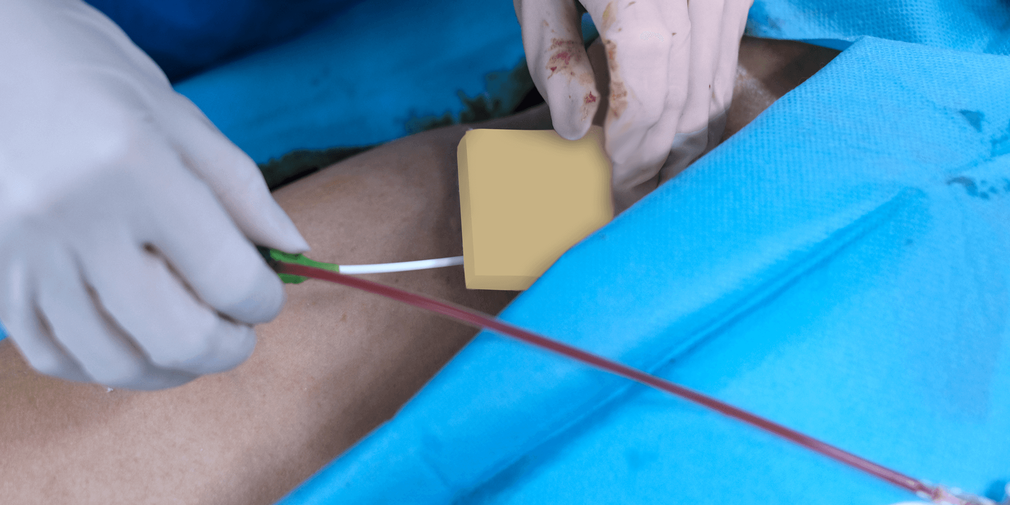 Surgical Hemostasis Surgical Hemostasis