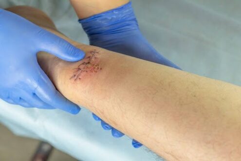Surgical Wound Care