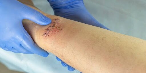 Surgical Wound Care Surgical Wound Care