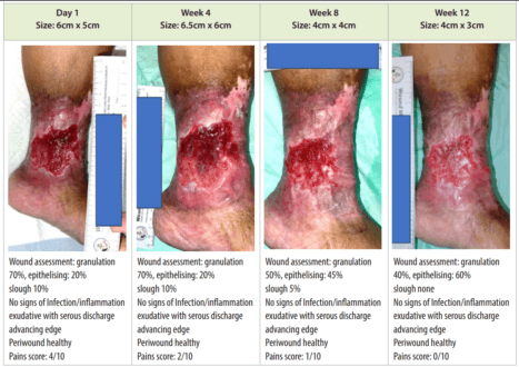 Evaluation of a Bioactive Microfibre Gelling Dressing in the Management of Chronic Wounds: A Case Series