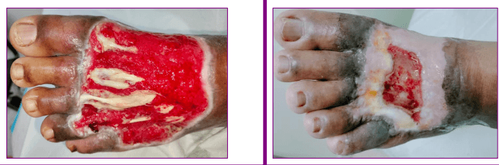 Accelerating Wound Healing in Chronic Wound and Post Surgical Wound