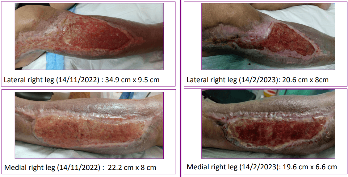 Accelerating Wound Healing in Chronic Wound and Post Surgical Wound