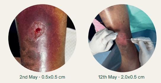 Expediting Wound Healing in Uncontrolled Diabetic Patients