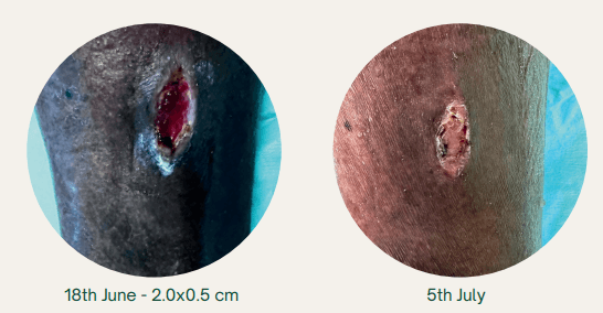 Expediting Wound Healing in Uncontrolled Diabetic Patients