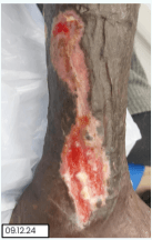 Venous Leg Ulcer Treatment in a New Lower Limb