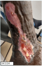 Venous Leg Ulcer Treatment in a New Lower Limb