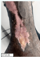 Venous Leg Ulcer Treatment in a New Lower Limb