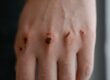 Skin Microbiome
