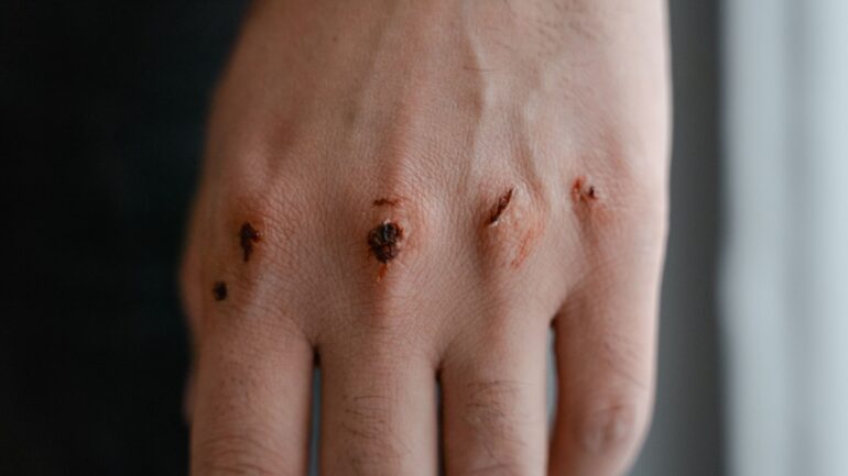 Skin Microbiome